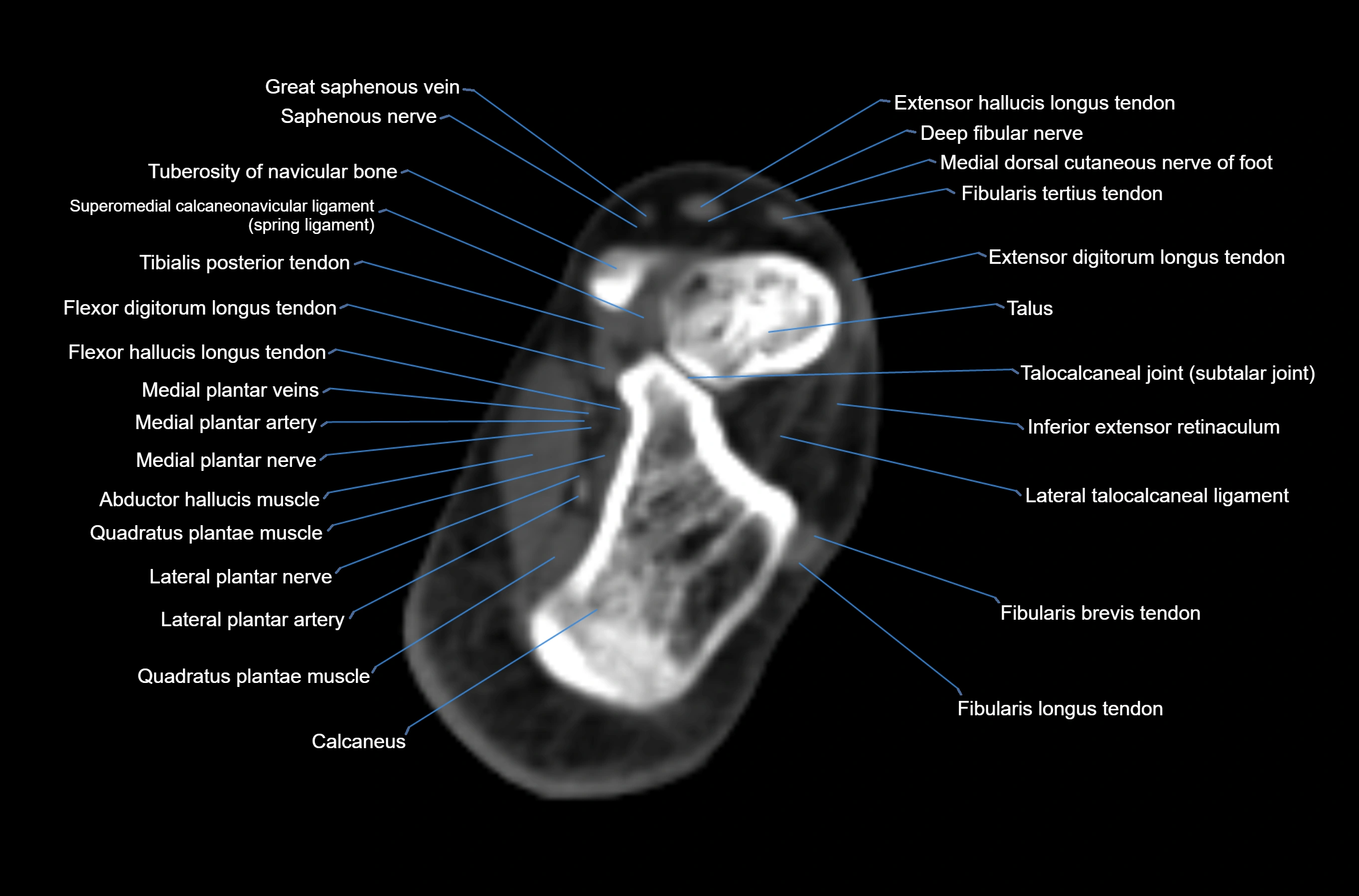 CT Ankle axial cross sectional anatomy labelled image -00040.webp